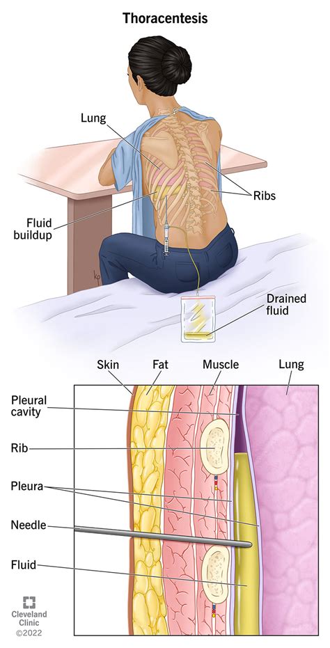 Pleural Tap Procedure Cheapest Prices | micoope.com.gt