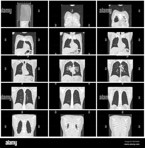 Lung ct scan hi-res stock photography and images - Alamy