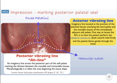 Posterior Palatal Seal Flashcards | Quizlet