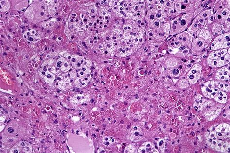 Pathology Outlines - Adrenal cortical adenoma