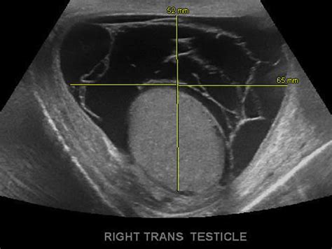 Scrotal ultrasound after acute rupture of hydrocele with visible ...