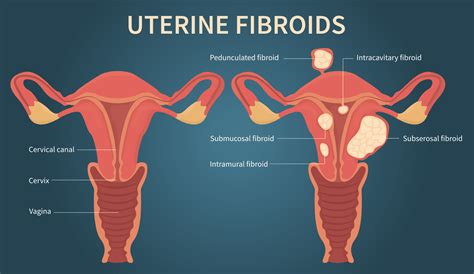 Peppermint Tea and Fibroids: Unraveling the Connection | Just Tea