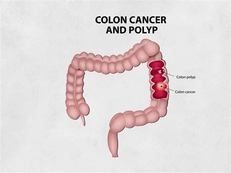 Polypectomy Procedure Cape Town | Gastric Polyp Removal