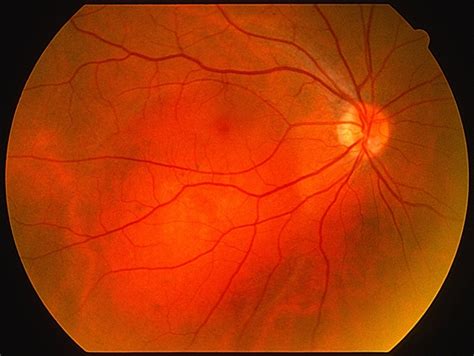 Choroidal Hemangioma - Retina Image Bank