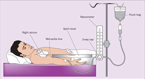 Central Venous Pressure (CVP) Line