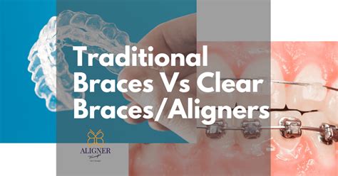 Traditional Braces vs Clear Braces/Aligner - Full Guide