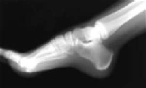 Calcaneal apophysitis: Simple diagnosis, simpler treatment | MDedge ...