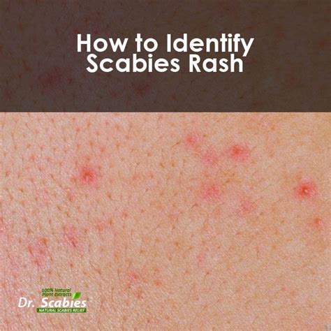 Pin on scabies