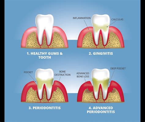 5 Foods That Promote Healthy Teeth And Gums - Arcadia Perio for ...