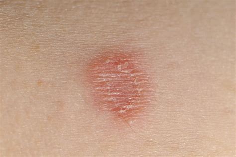 Pictures of Skin Infections: Causes and Treatments