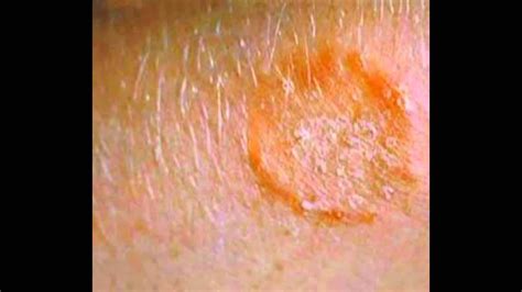 Skin Fungus Signs Symptoms Treatment HD | Doovi