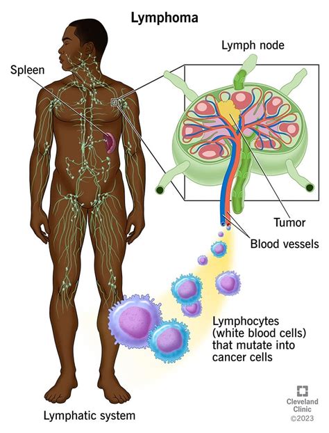 Lymphoma: Symptoms, Causes and Treatment