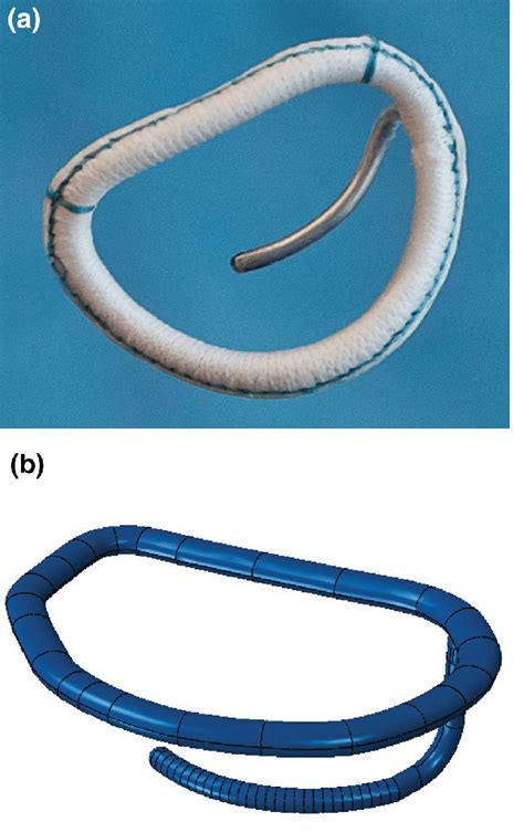 Novel annuloplasty ring with a sub-valvular element for correction of ...