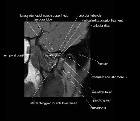 Temporomandibular Joint Anatomy | MRI TMJs Anatomy | Free Sagittal ...