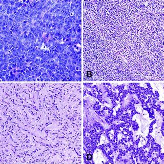 (PDF) Ewing Sarcoma