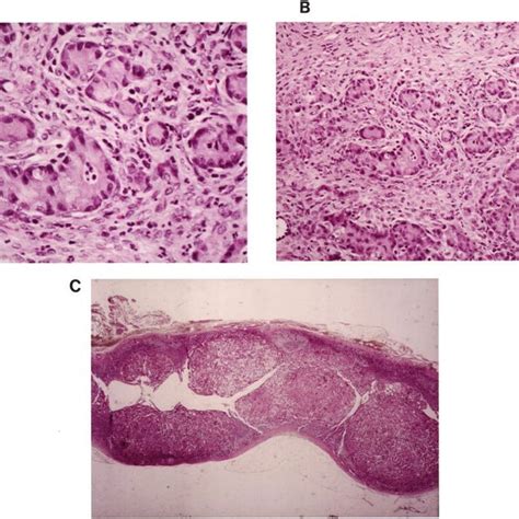 Metastatic mucinous adenocarcinoma in the ovaries (A and B) of a ...