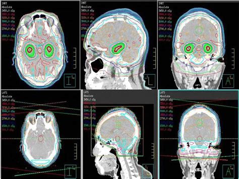 Tailored Radiation for Brain Metastases Reduces Cognitive Impact ...