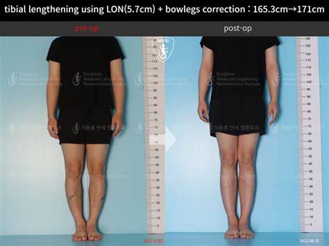 tibial lengthening using LON(5.7cm) + bowlegs correction : 165.3cm→ ...