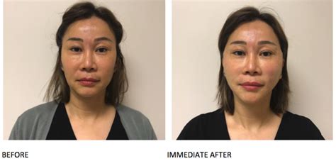 MINT PDO Before-After - Serenity MedSpa