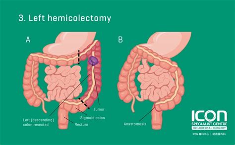 Colorectal resection (colectomy) — Icon Specialist Centre