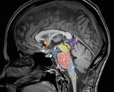 Sagittal midline of the brain: normal anatomy | Radiology Case ...