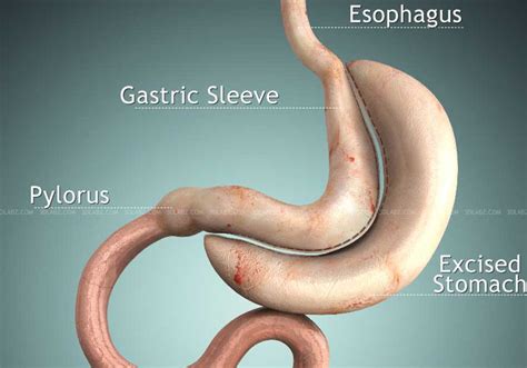 Vertical Sleeve Gastrectomy 3D Illustration