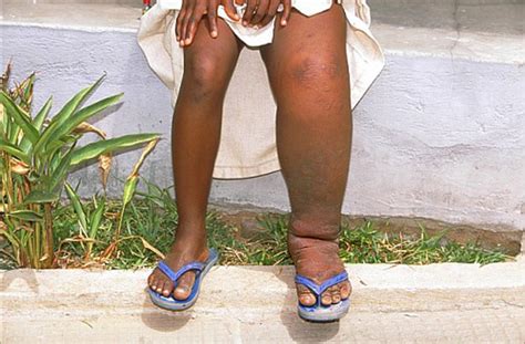 The New Humanitarian | Elephantiasis thrives amid funding gap