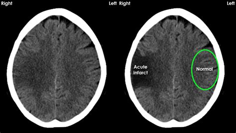 Acute CT Brain - Acute ischaemia