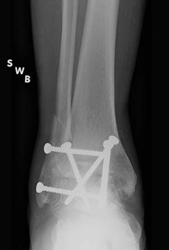 Comparing Ankle Arthrodesis to Ankle Arthroplasty - Center for Limb ...