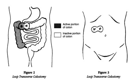 Colostomy Poop