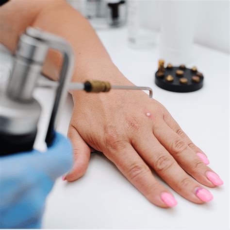 Cryotherapy For Wart Removal – PedCare