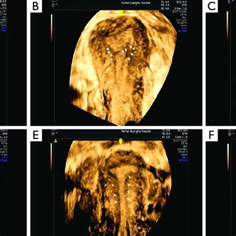 Prediction model of ongoing pregnancy and live birth in IUA patients ...