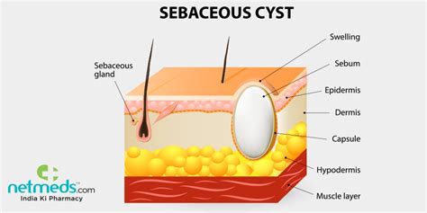 Sebaceous Cyst Vs Lipoma | Sitelip.org