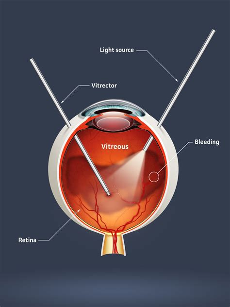 Vitrectomy Side Effects - Beverly Hills, CA