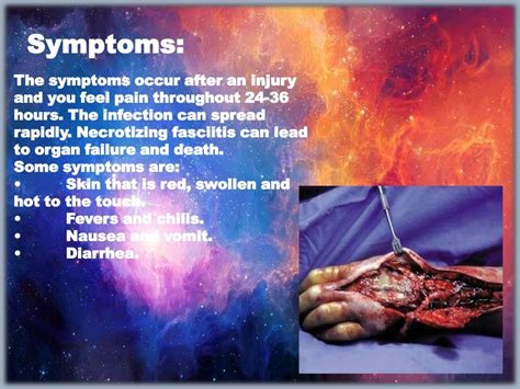 Necrotizing fasciitis (1)