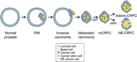 Prostate cancer progression and cancer stem cells. Prostate cancers ...