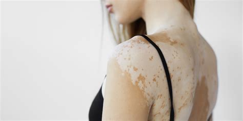 Vitiligo - Sun Luis Obispo, CA | Coastal Dermatology + Aesthetics