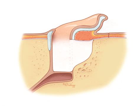 Postauricular Meatoplasty – Oto Surgery Atlas