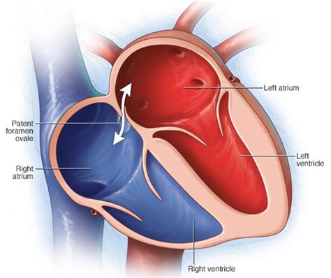 Patent Foramen Ovale - Causes, Symptoms, Diagnosis & Treatment