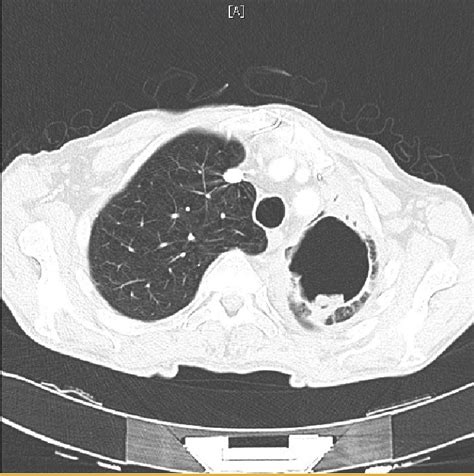 Cavitating Lung Lesion and Recurrent Chest Infections