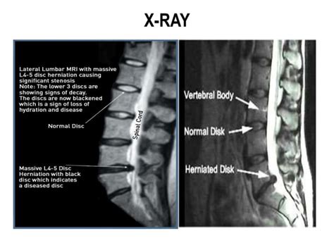 Herniated Nucleus Pulposus | PPT