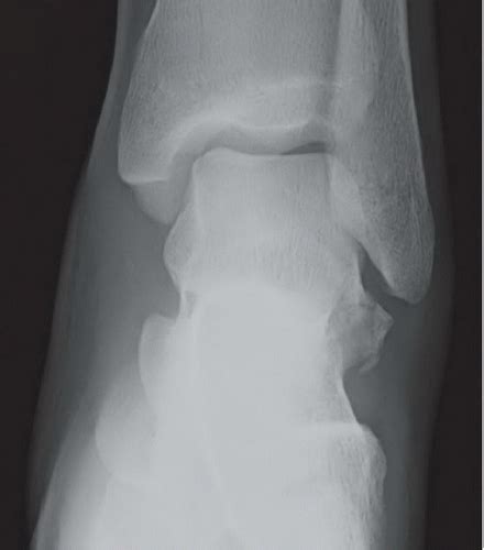 Lateral Process of Talus Fracture | Radiology Key