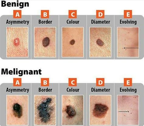 ABCDE to differentiate between benign and melignant mole - MEDizzy