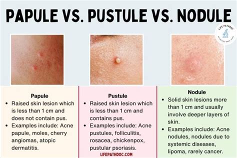 Papule vs Pustule vs Nodule: Pictures, Differences, and Causes