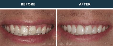 Before & After Photos ••• Ambiance Dental • 403-261-7661