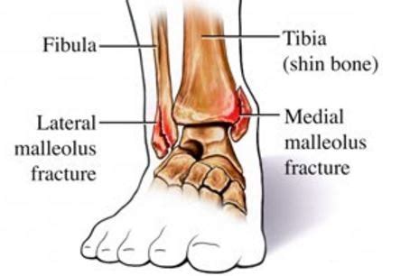 Medial Malleolus Fracture - Treatment, Symptoms, ICD 10, Causes, What