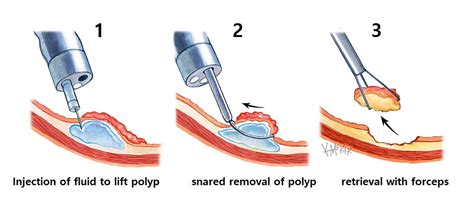 7 Photos Carpet Polyp And Review - Alqu Blog