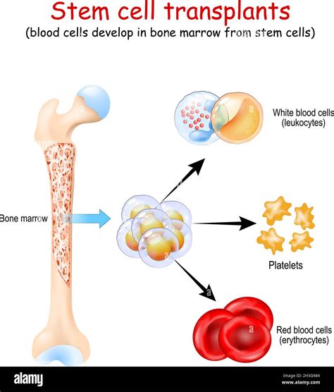 Stem cell transplants. blood cells develop in bone marrow from stem ...