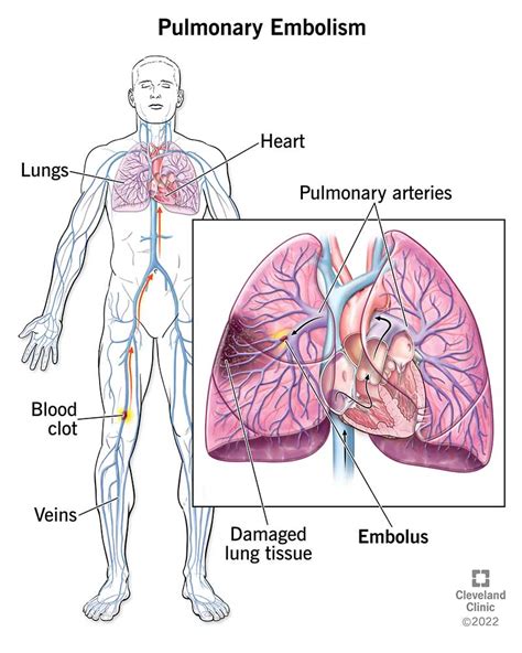 Pulmonary Embolism: Symptoms, Causes & Treatment