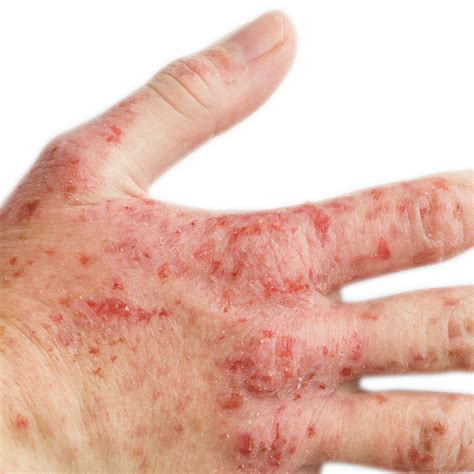 Feeling itchy this winter? You may have eczema, a condition that causes ...